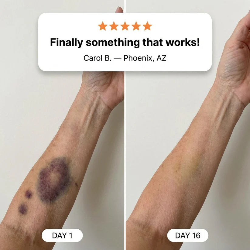 Customer-reported visible bruise appearance after consistent use